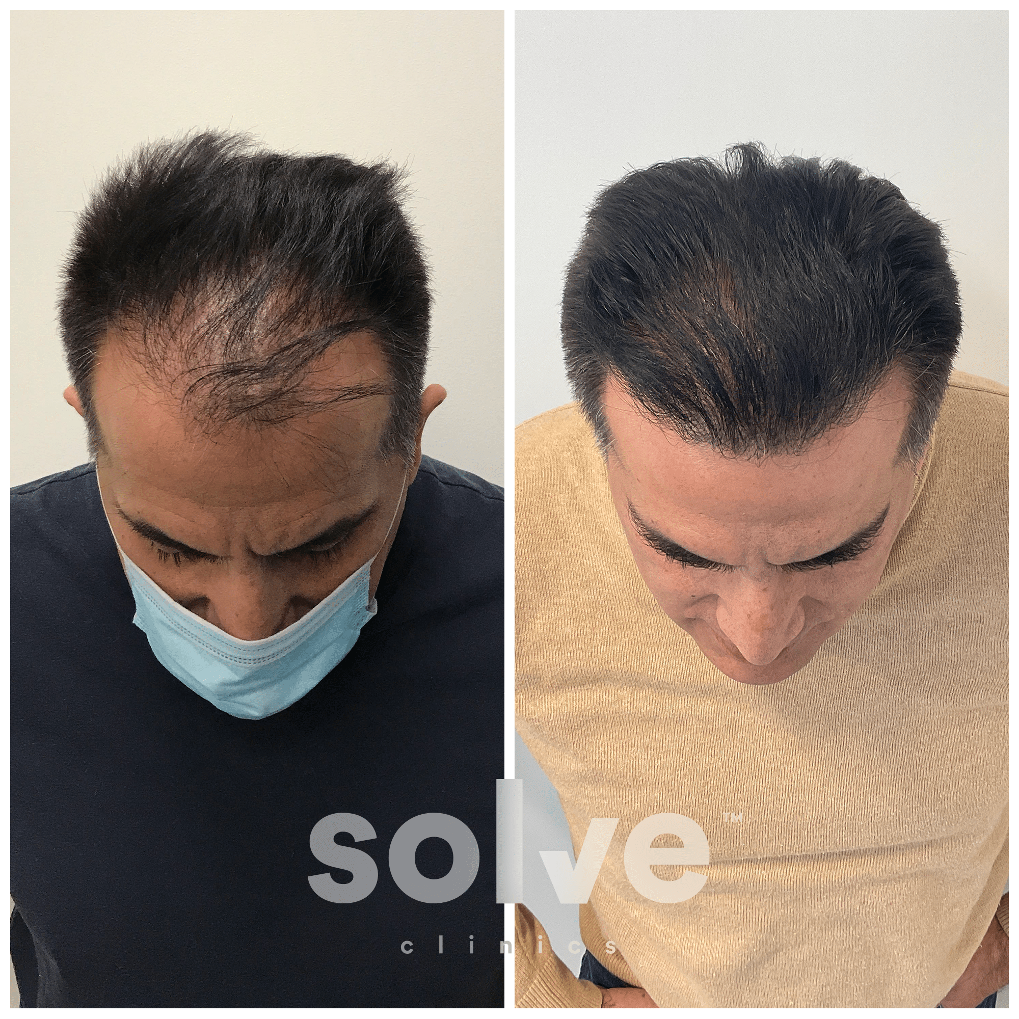 Alex_before-and-after-hairline-surgery-before-after_1500_Top