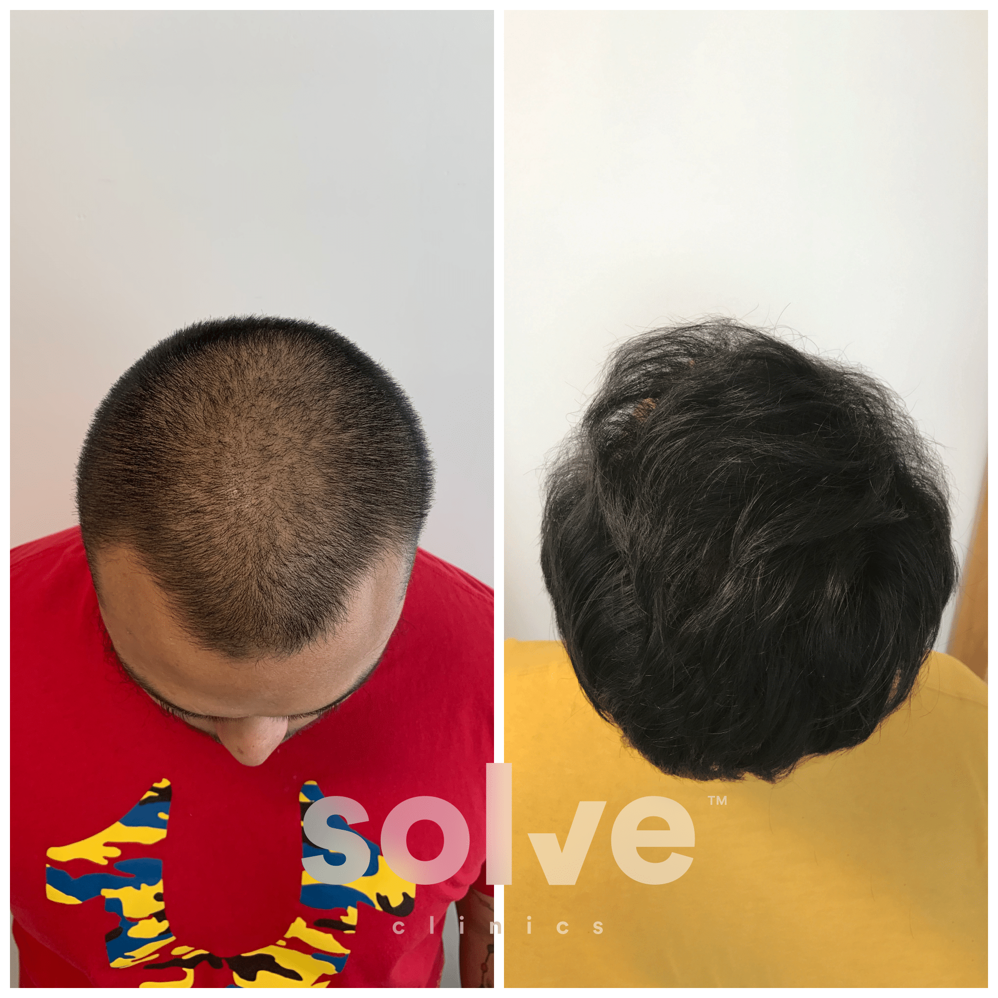 FUE 1600 grafts hair transplant before and after_Vandan E