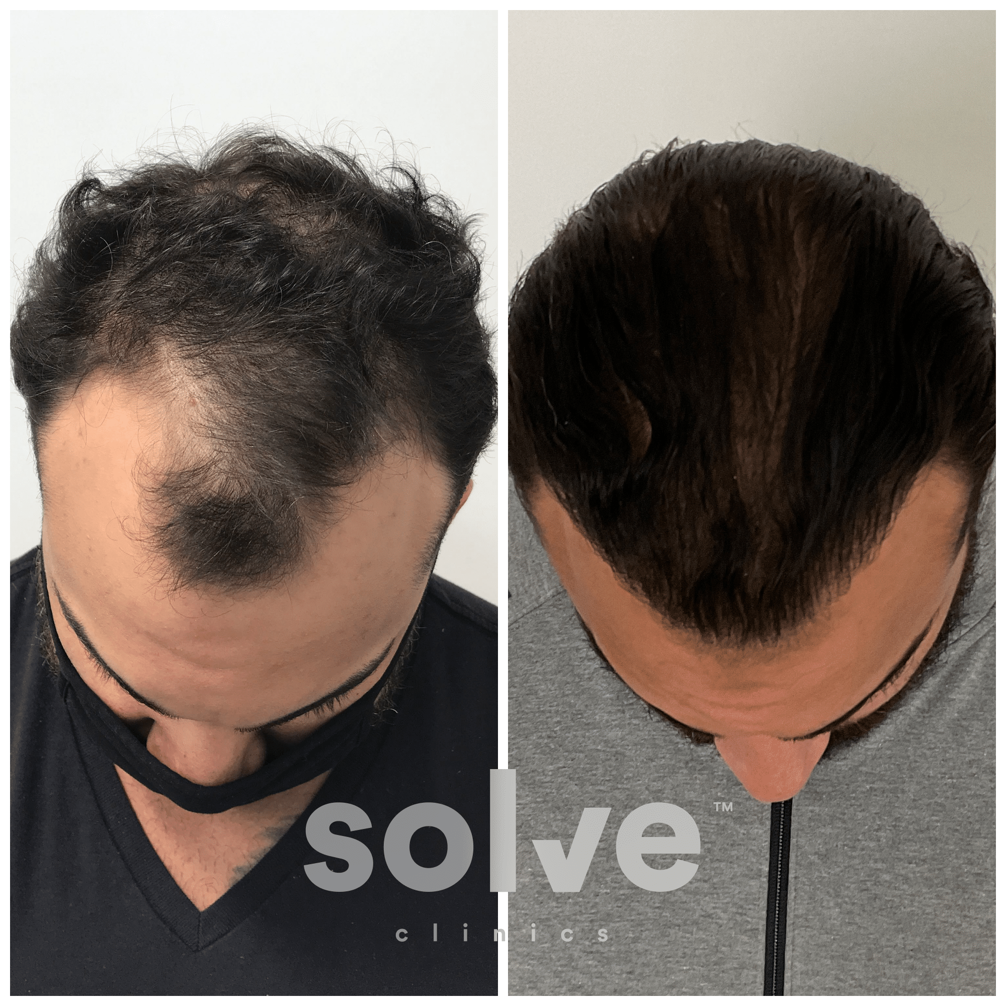 AJ_before-and-after-hairline-surgery_1800_Top