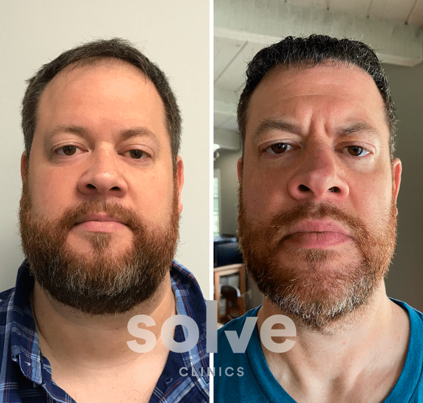 Andrew_FUE-3500-grafts-hair-transplant-before-and-after_front