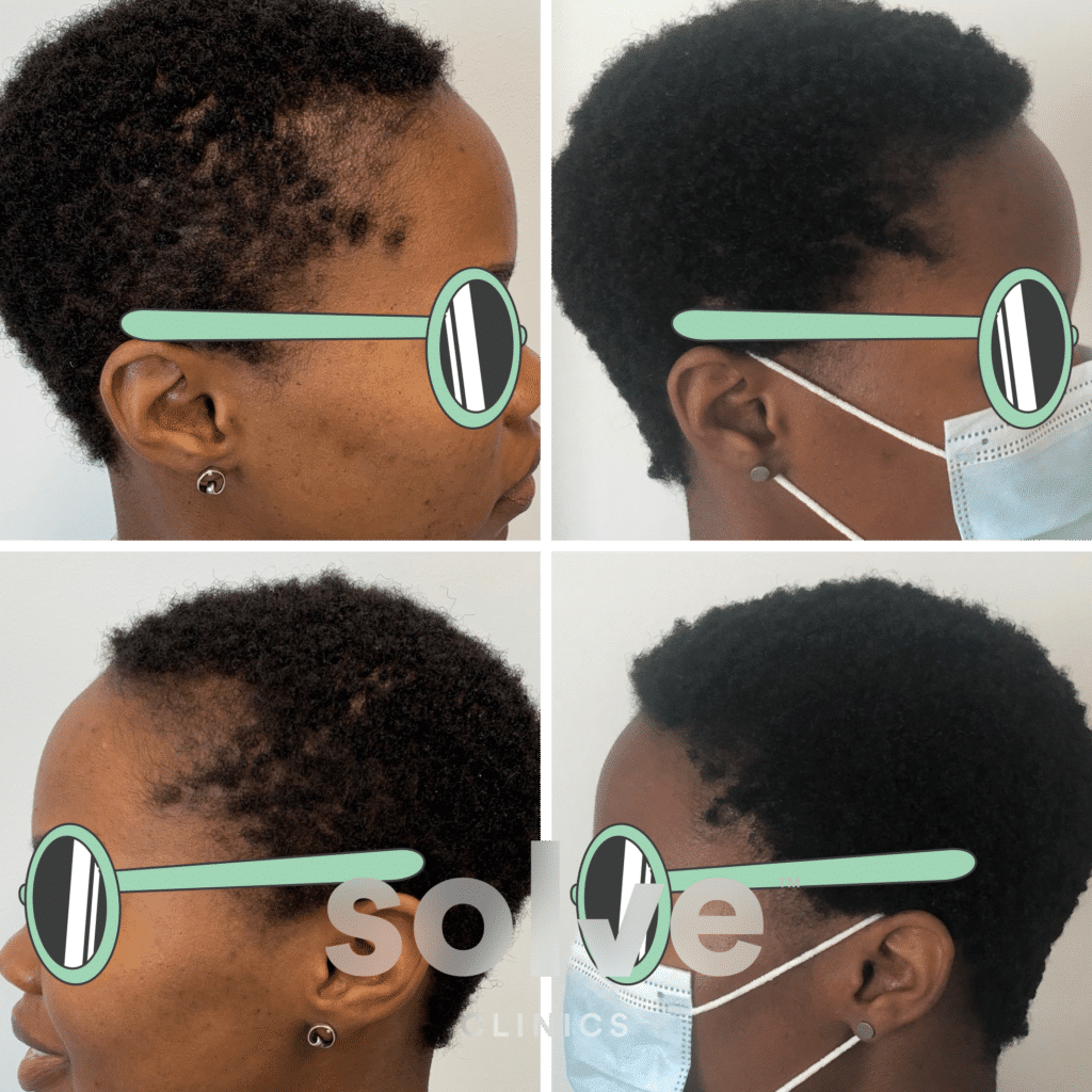 Angela_FUE-1400-grafts-hair-transplant-before-and-after_side