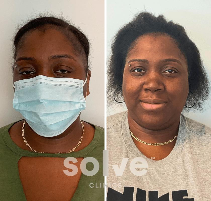 Charhonda_FUE-1400-grafts-hair-transplant-before-and-after_front