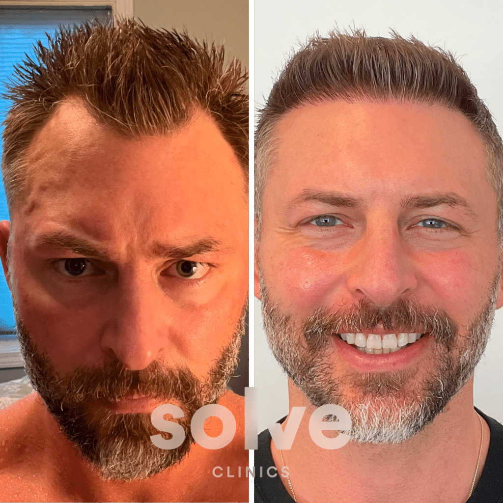 Christopher_FUE-1400-grafts-hair-transplant-before-and-after_front