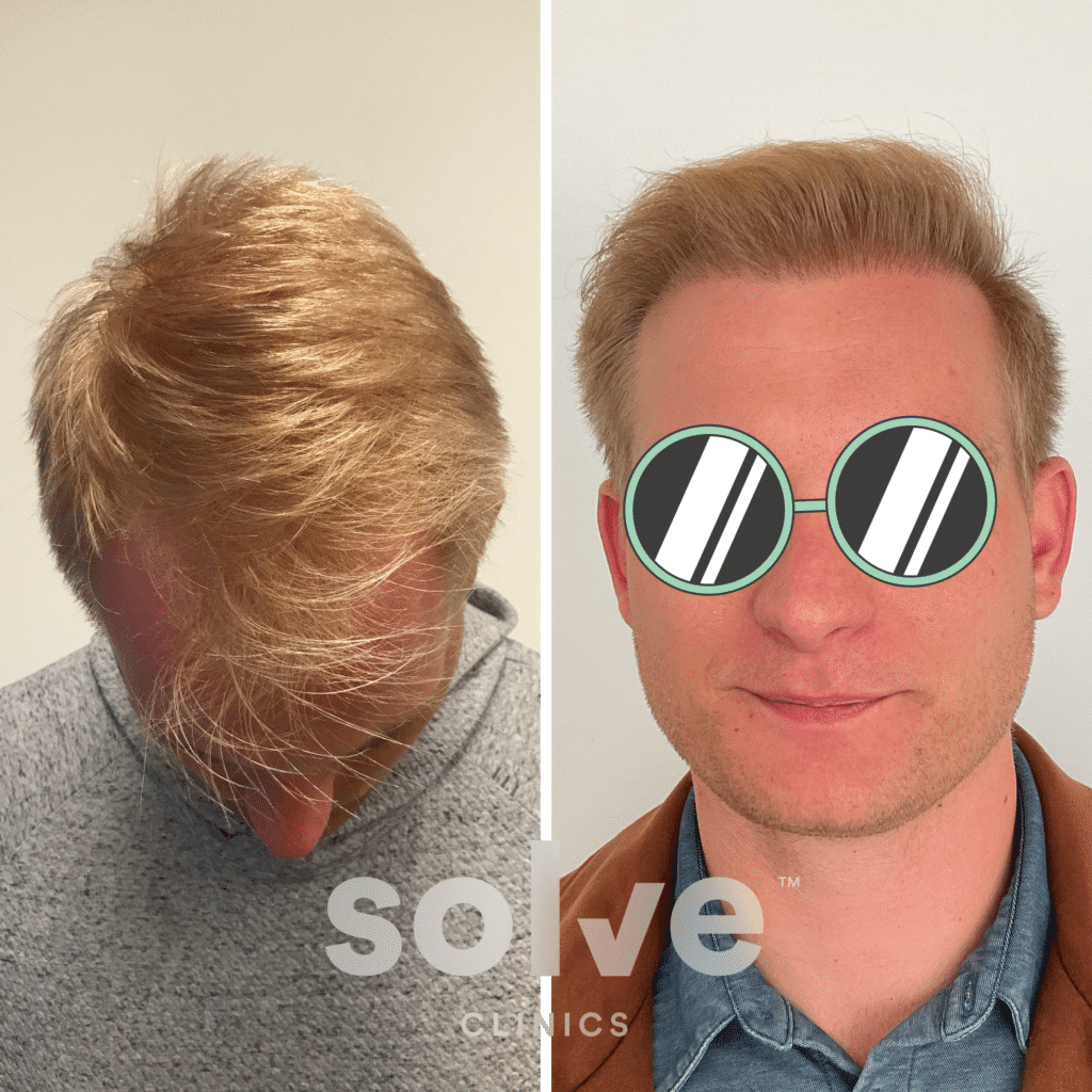 Connor_M_before-and-after-hairline-surgery_1400-front