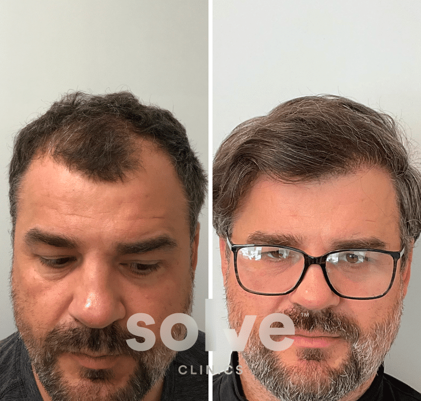 Cristian_FUE-1800-grafts-hair-transplant-before-and-after_front