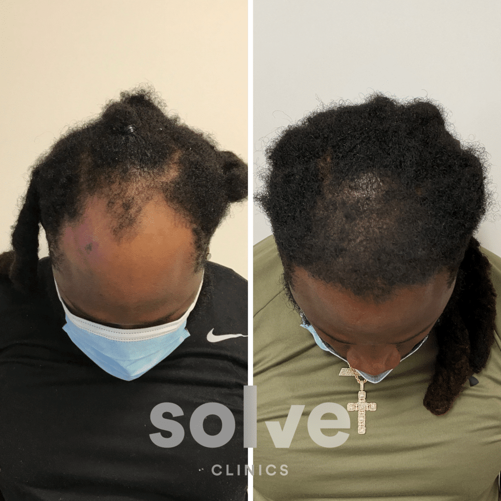 1500 De-Marcus before and after hairline surgery _top