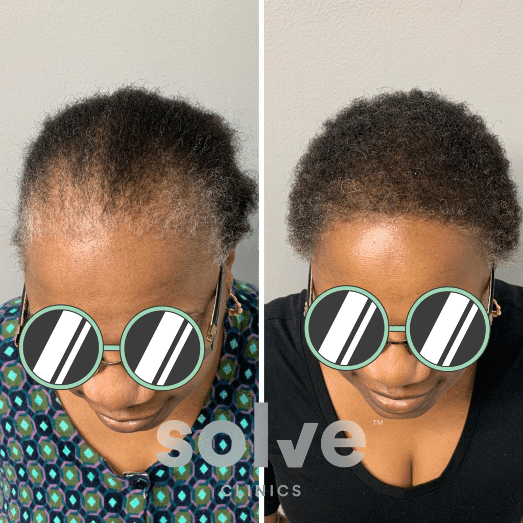 Deborah_FUE 1600 grafts hair transplant before and after_front