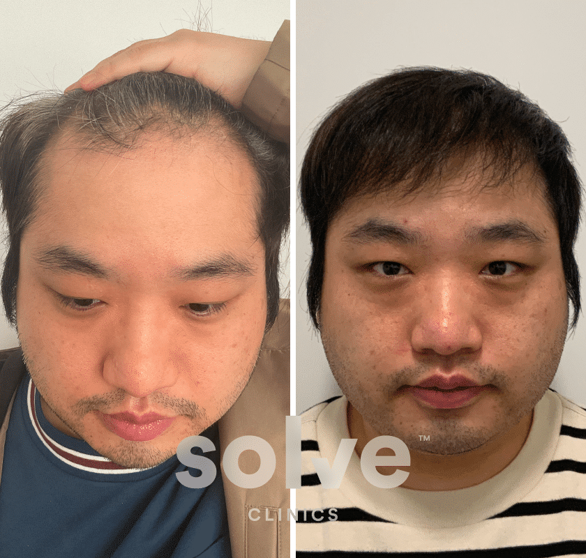 Denis_FUE 3500 grafts hair transplant before and after _front