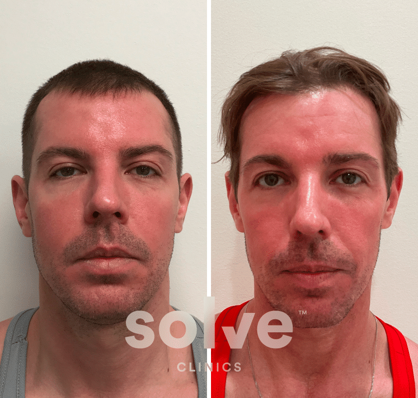 Denis_FUE 1400 grafts hair transplant before and after_front