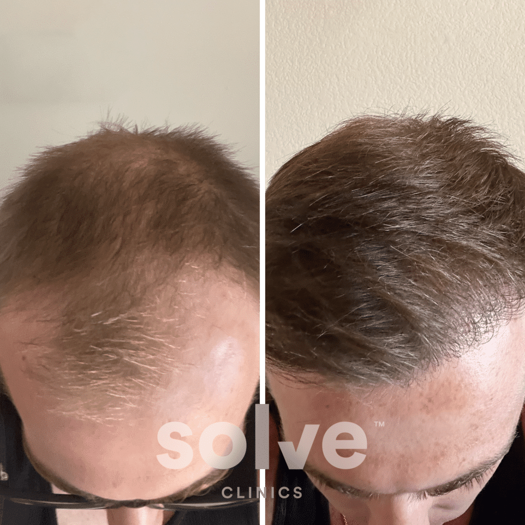 Drew_FUE 1800 grafts hair transplant before and after_top