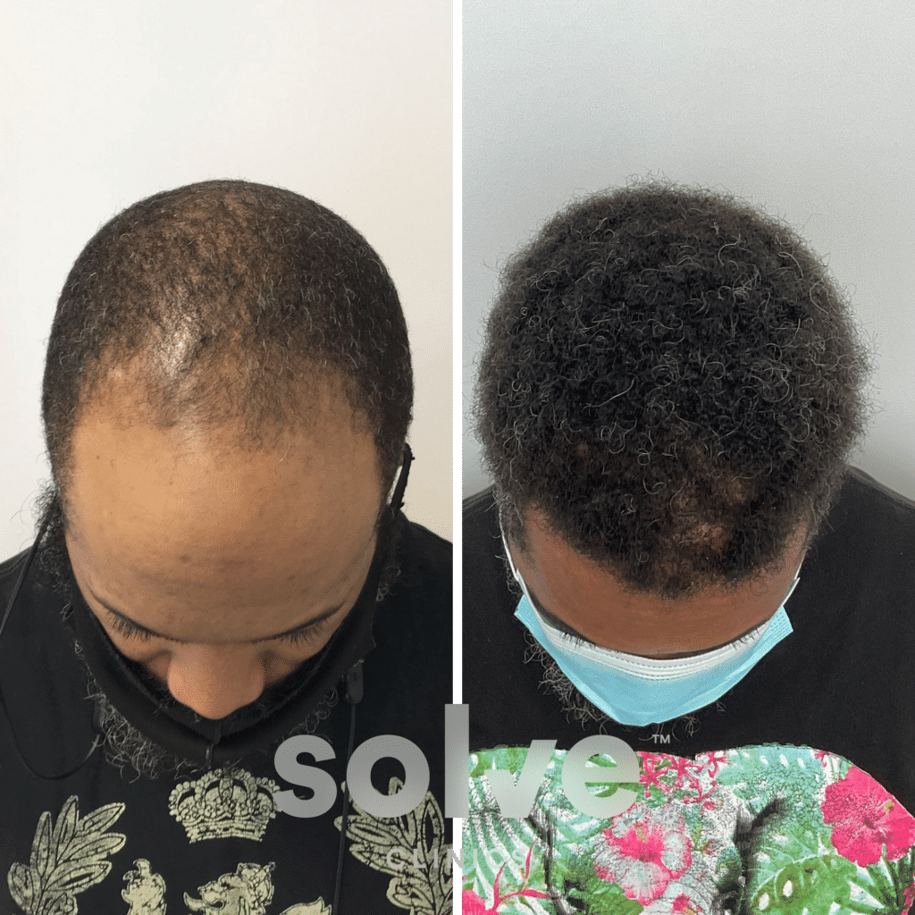 Eddie_before and after hairline surgery 1500_top