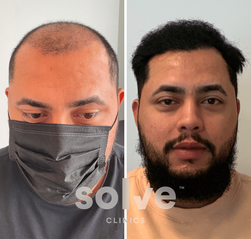 Edgar_FUE 3300 grafts hair transplant before and after_front