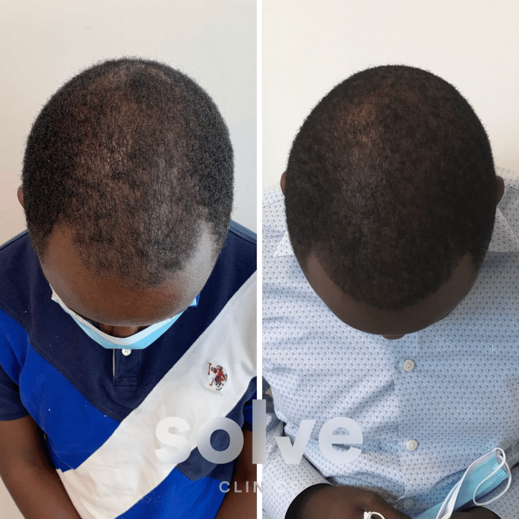 Gonzalves_before and after hairline surgery_2000_top