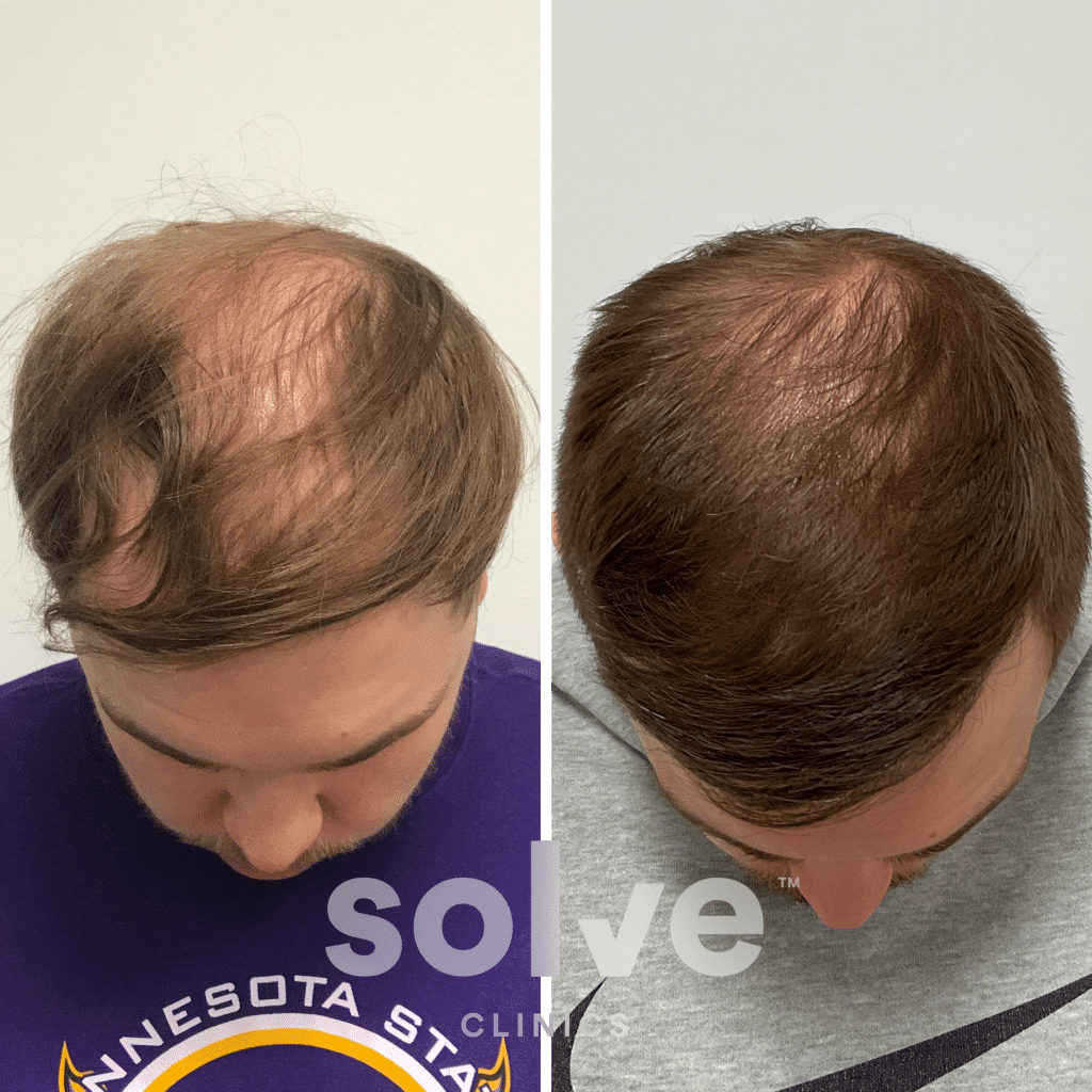 Griffin FUE 2000 grafts hair transplant before and after_top