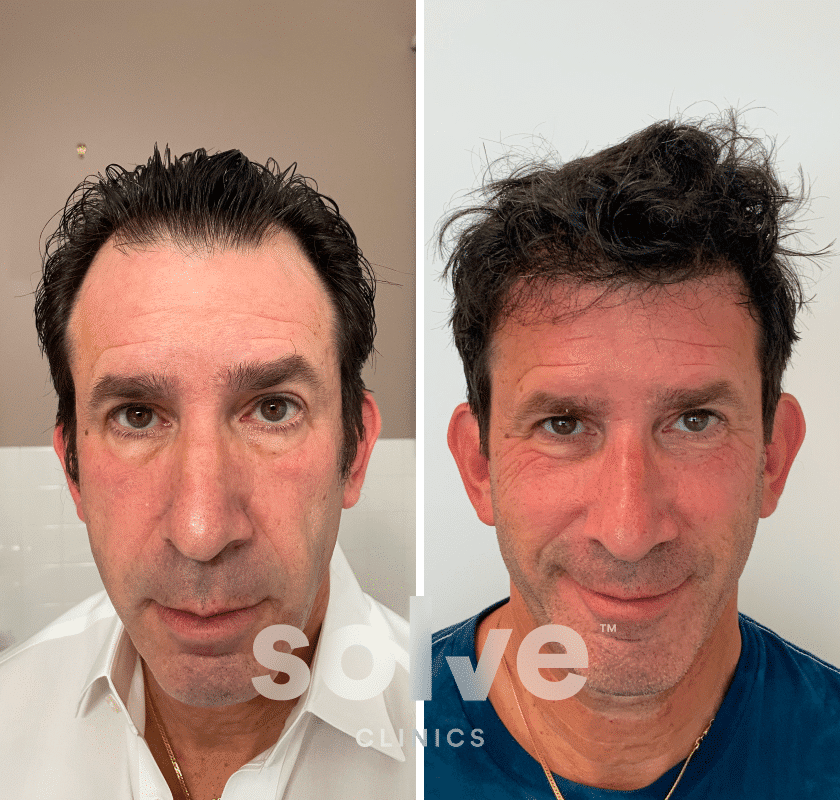 Ian_FUE 1600 grafts hair transplant before and after_front