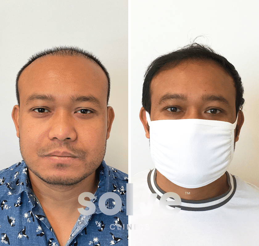 Indeshwar_before and after hairline surgery before and after hairline transplant before and after_front