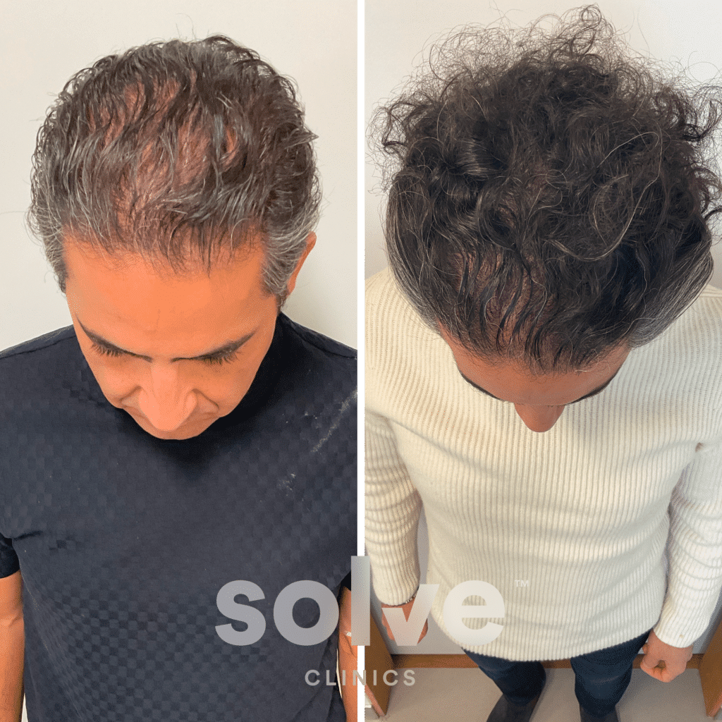 Jaber_FUE 2200 grafts hair transplant before and after png