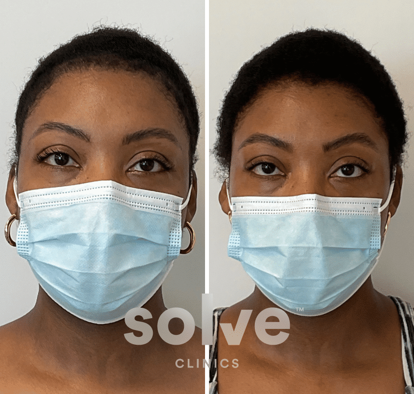 Jarrie_FUE 1600 grafts hair transplant before and after_front