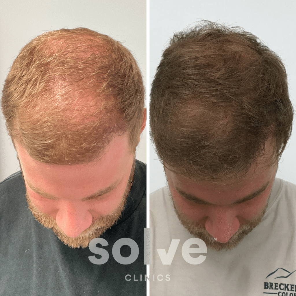 Jaymes_FUE 1400 grafts hair transplant before and after_top