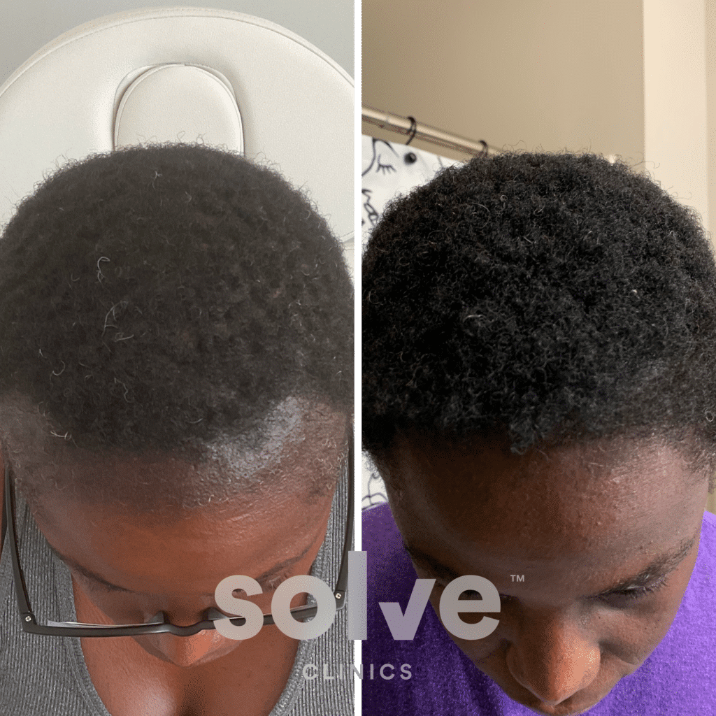 Jessy_before and after hairline surgery 2000_toppng