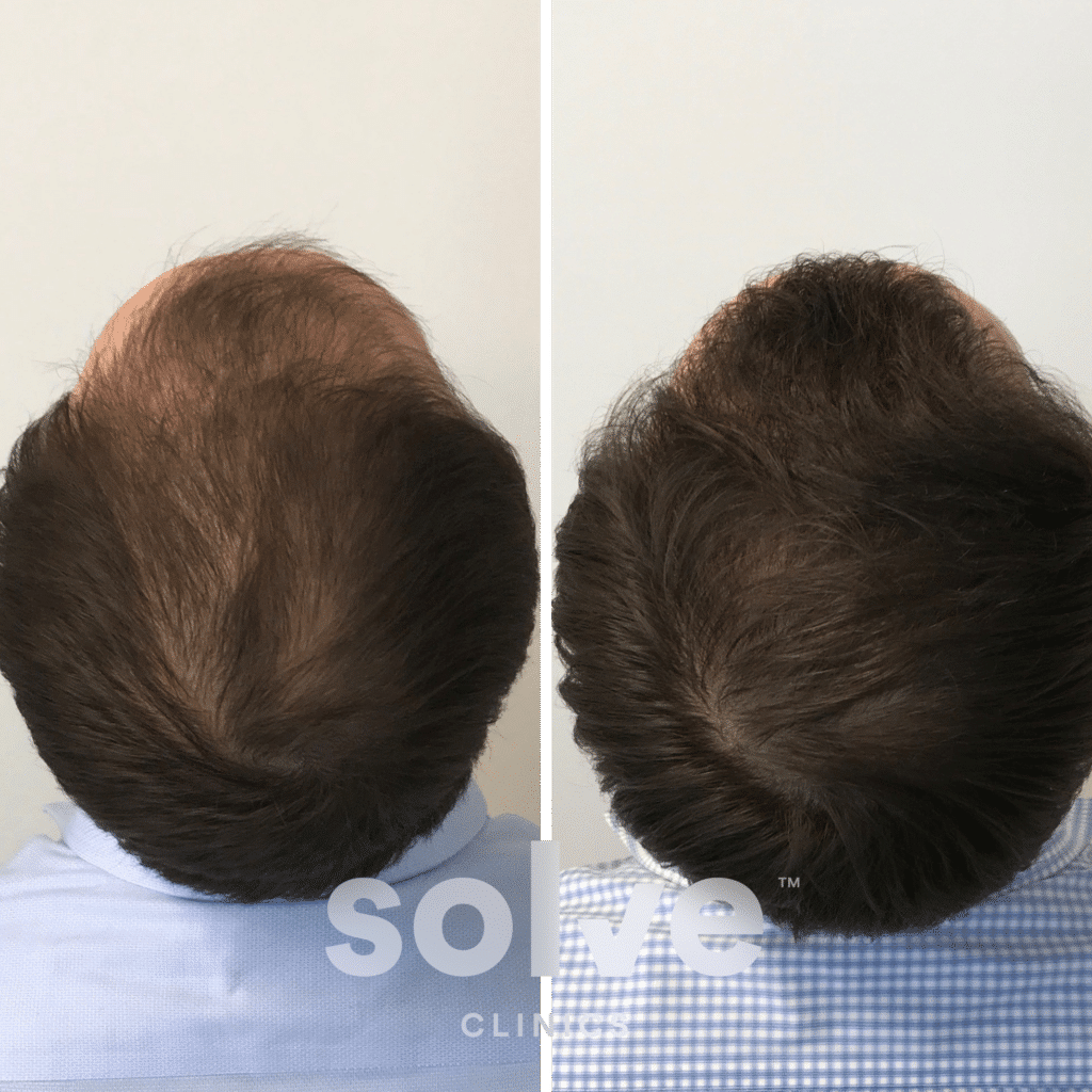 Jim_FUE 2000 grafts hair transplant before and after_top