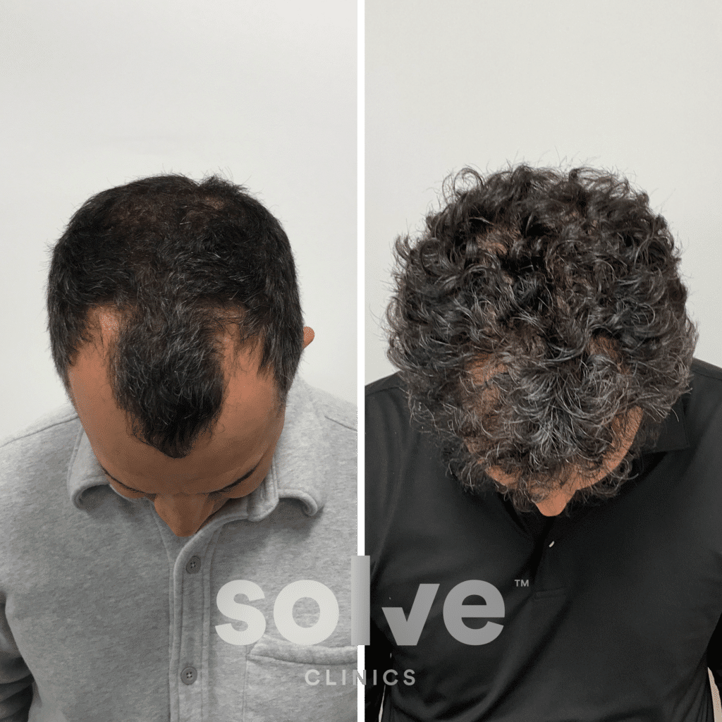 Joe_FUE 1800 grafts hair transplant before and after_top