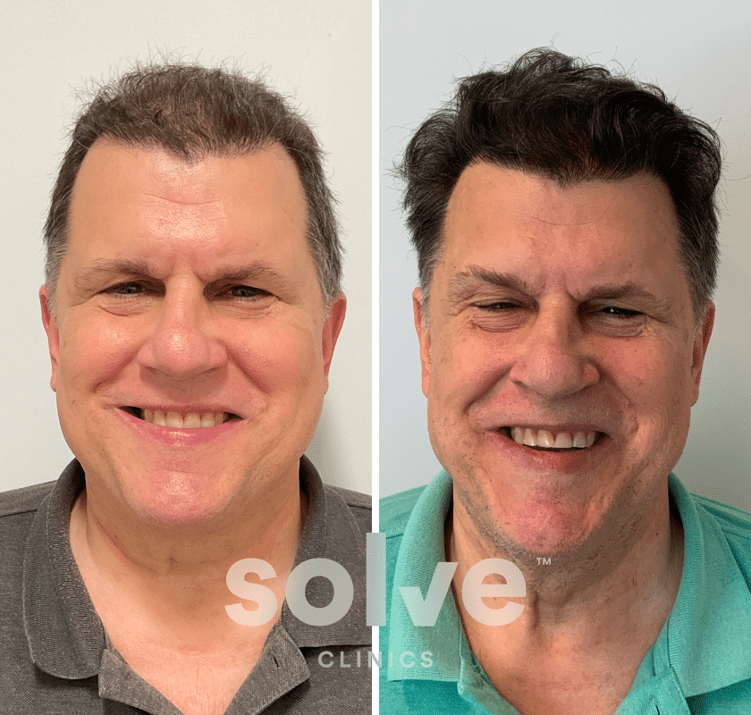 Joe_FUE 3500 grafts hair transplant before and after _front