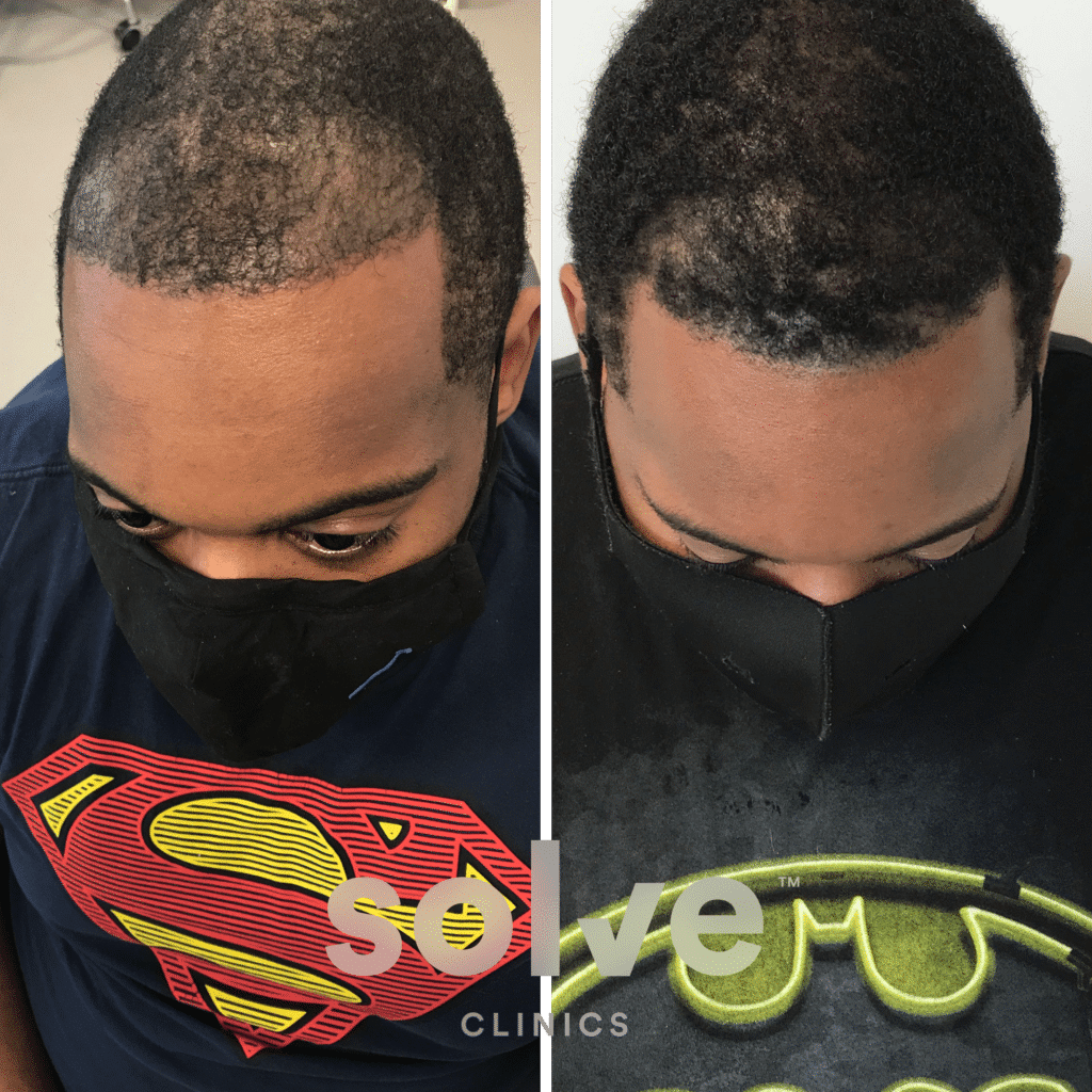 John_before and after hairline surgery 1400_top