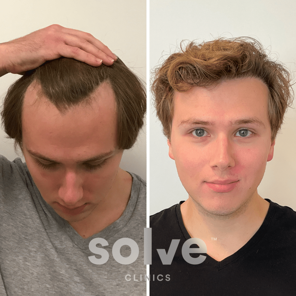 Kyle_FUE 2000 grafts hair transplant before and after_front