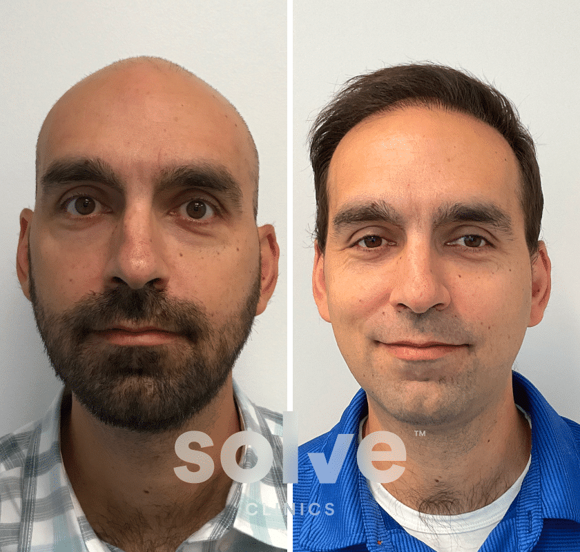 Lukas_before and after hairline surgery_1300_front