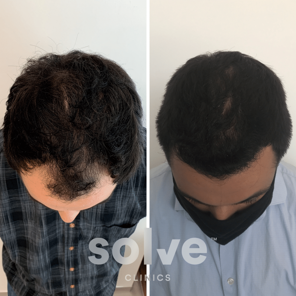 Marcus_top_before and after hairline surgery before and after hairline transplant before and after