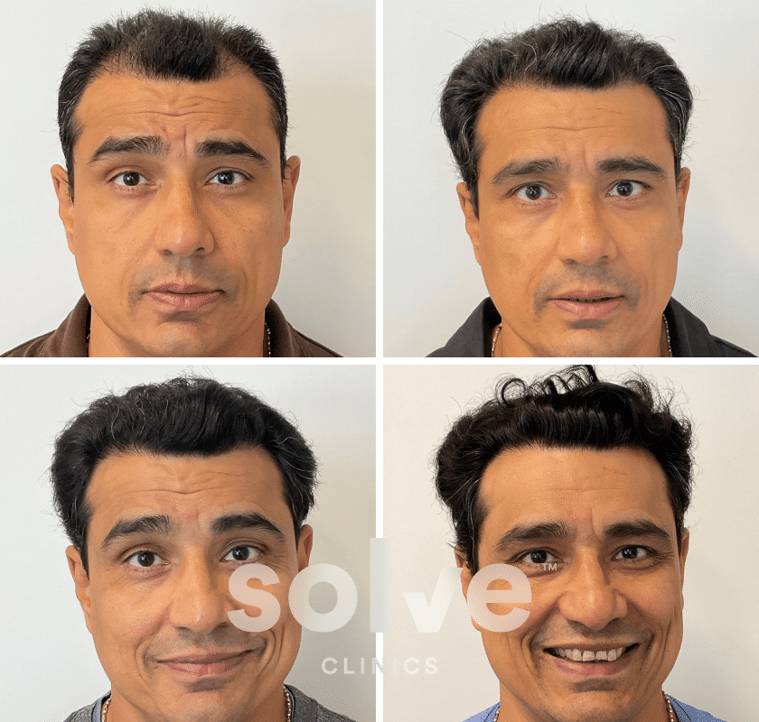 Mohit_FUE 2000 grafts hair transplant before and after_front