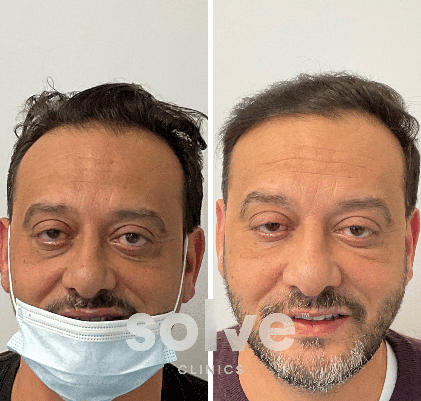 Molala_before and after hairline surgery_front