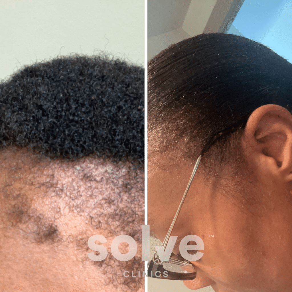 Natalie_FUE 2000 grafts hair transplant before and after _side