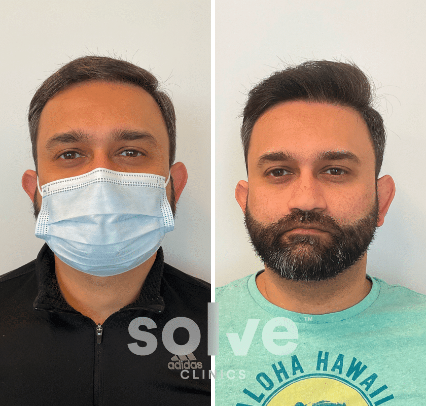 Nawroz_P_before and after hairline surgery 1600_front