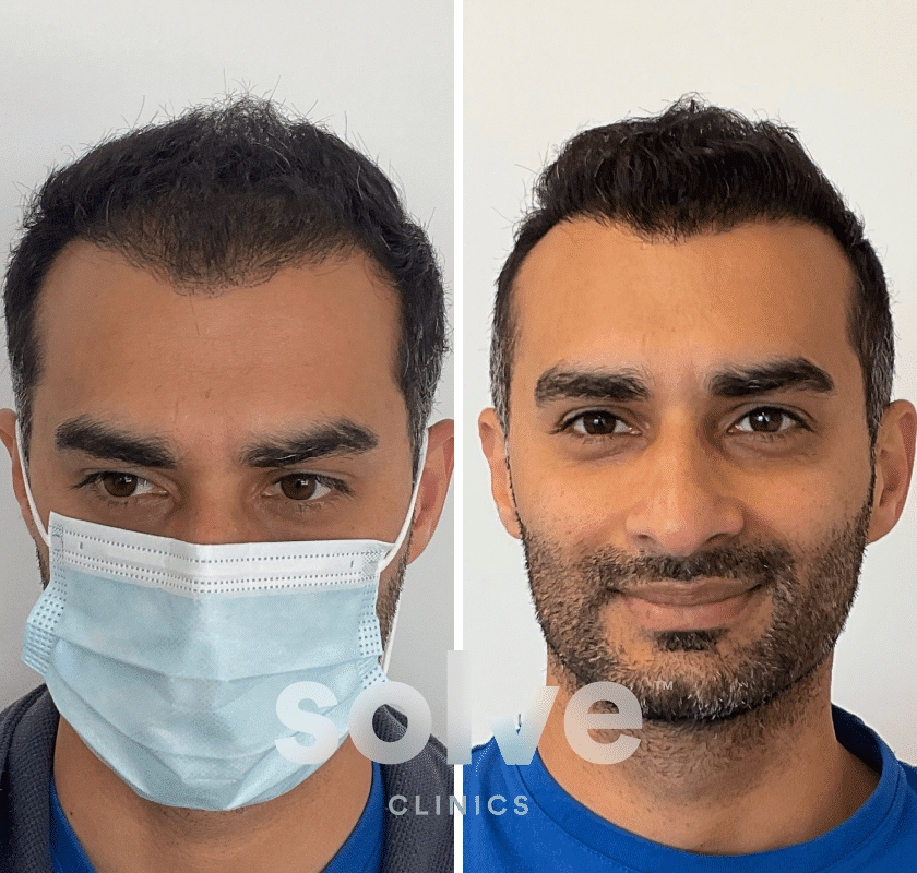 Hair Transplant 19