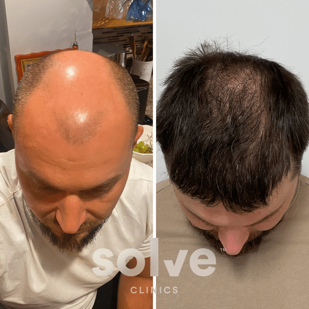 Ryan_FUE 3600 grafts hair transplant before and after_top png