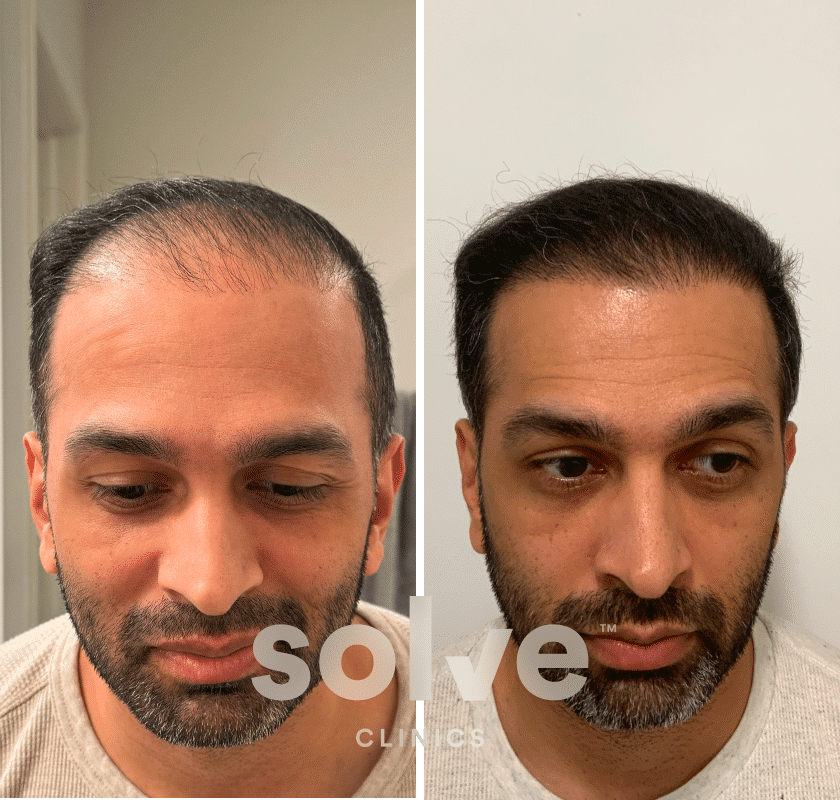 Sam_FUE 1300 grafts hair transplant before and after_front