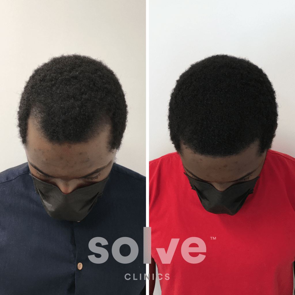 Seun_before and after hairline surgery 1200_top