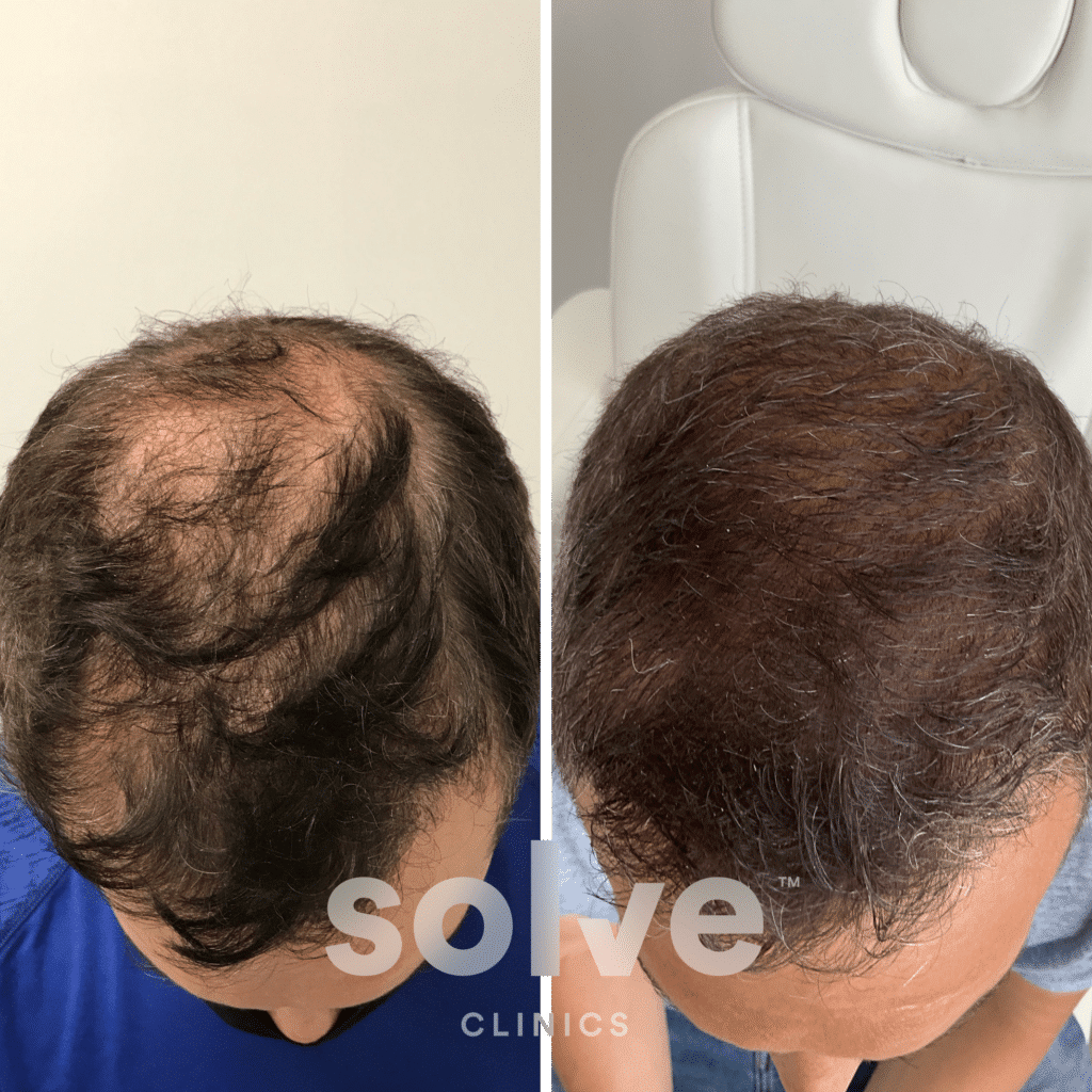 Steve_before and after hairline surgery before_3600_top