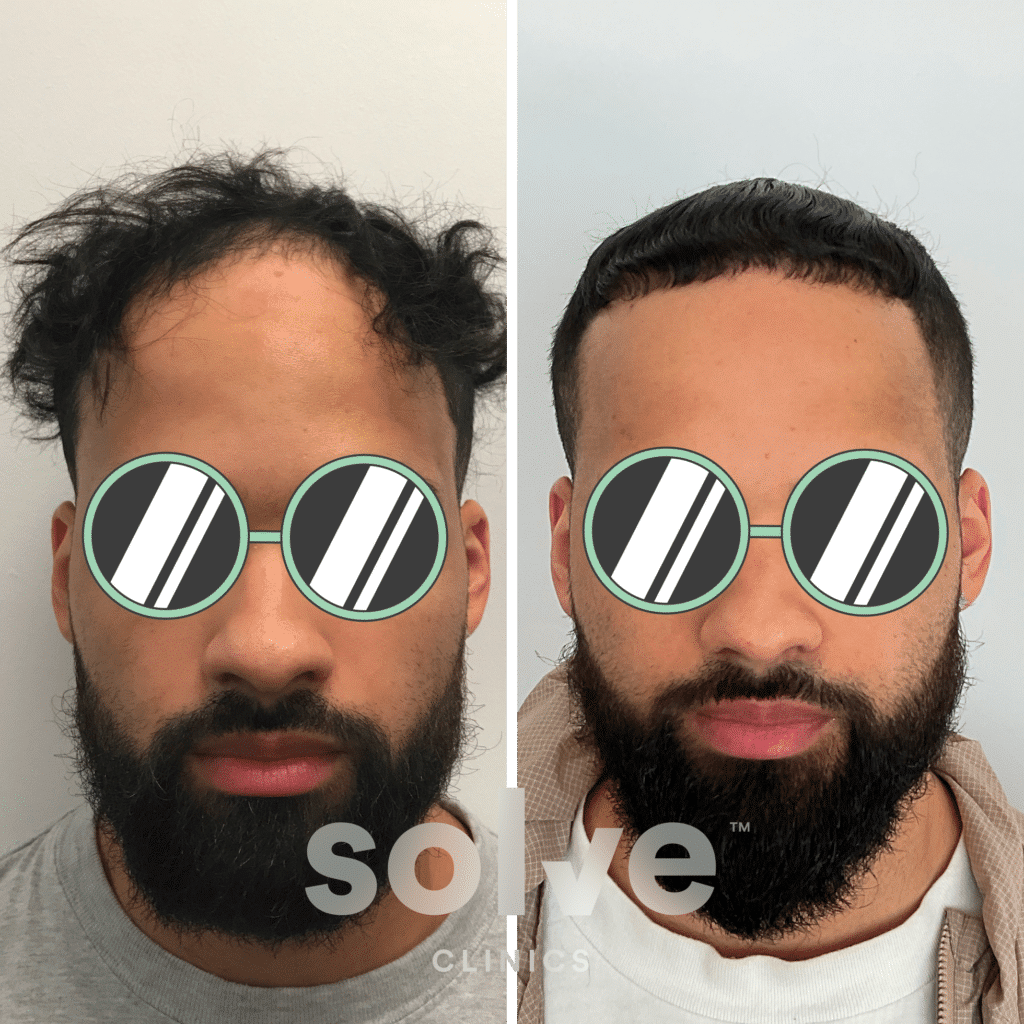 Zachary_FUE 1200 grafts hair transplant before and after_front